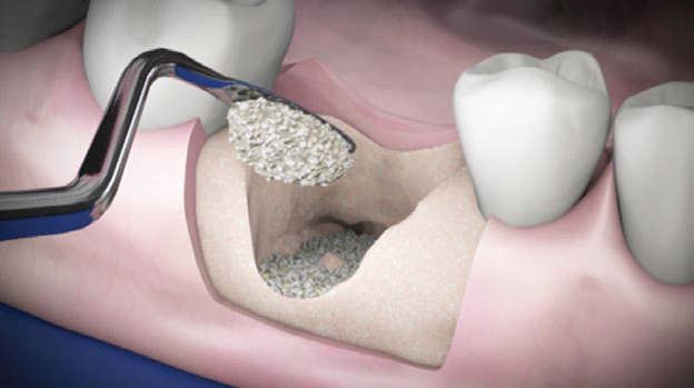 Gen-Os hidratado com o Gel TSV 